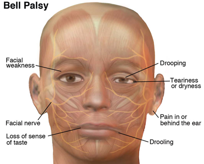 BellsPalsy_SM